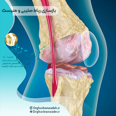 بازسازی رباط صلیبی و درمان منیسک